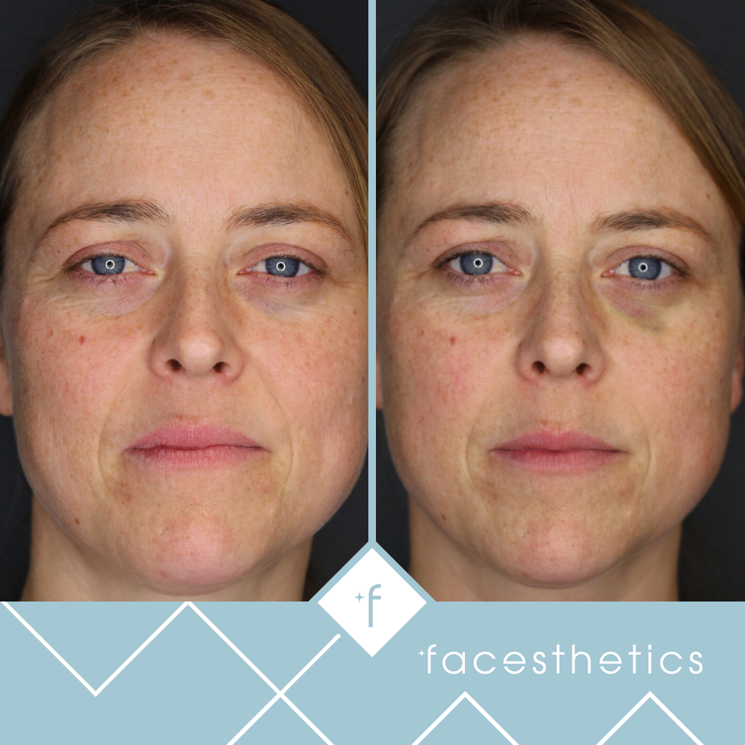 Tear Trough Fillers - Facesthetics