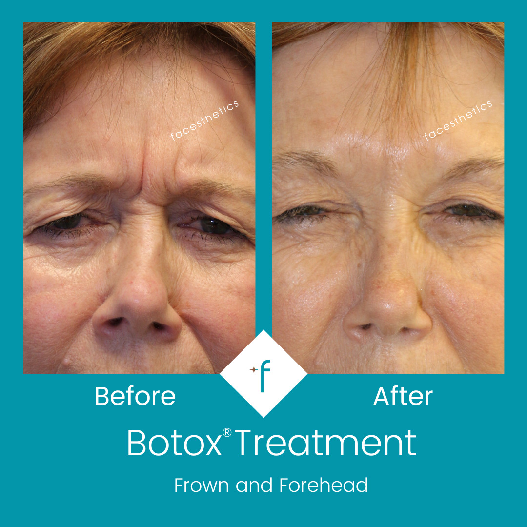 botox-before-after1-frown