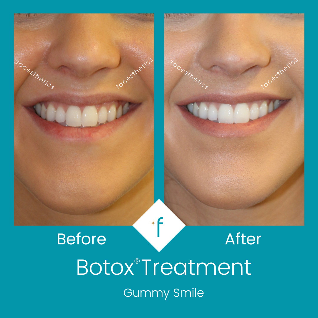 botox-before-after1-gummy