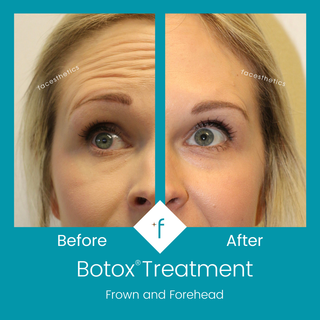botox-before-after2-frown