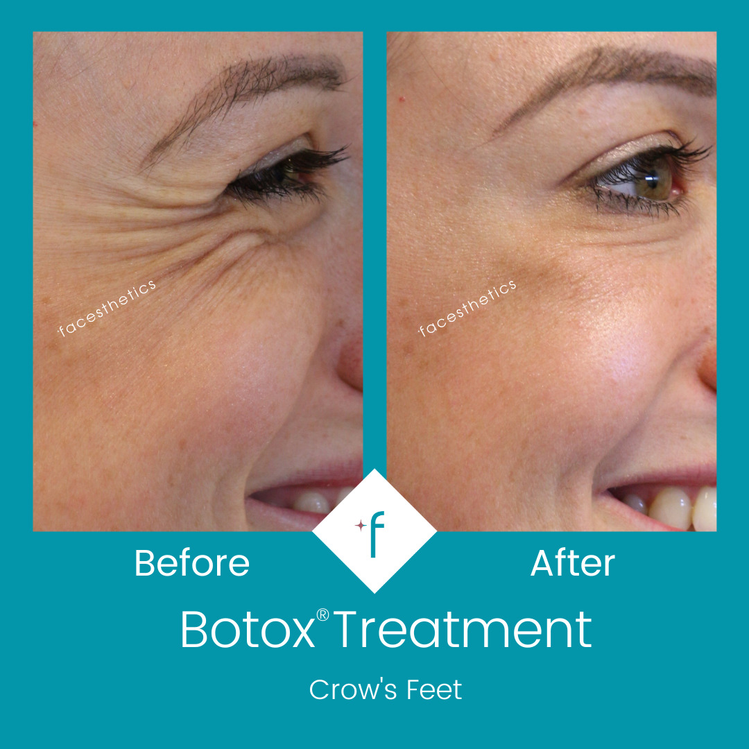 botox-before-after3-crowsfeet
