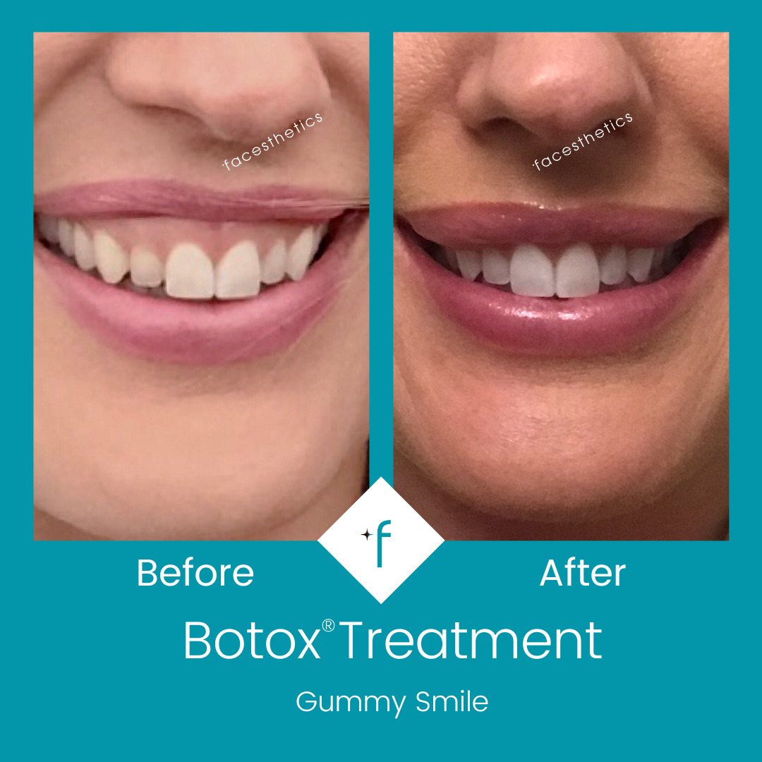 botox-before-after4-gummy