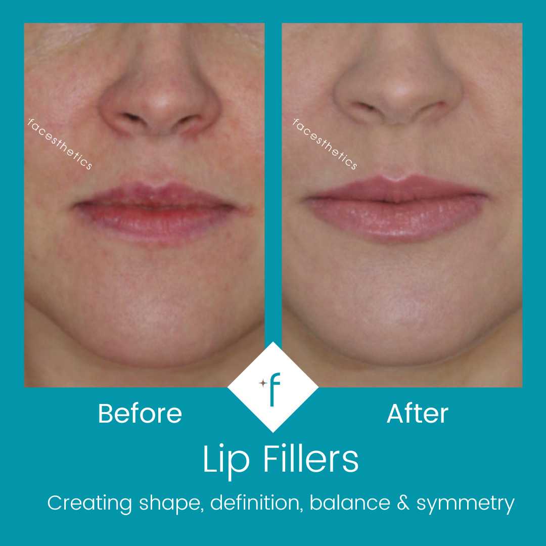 lip-fillers-before-after1