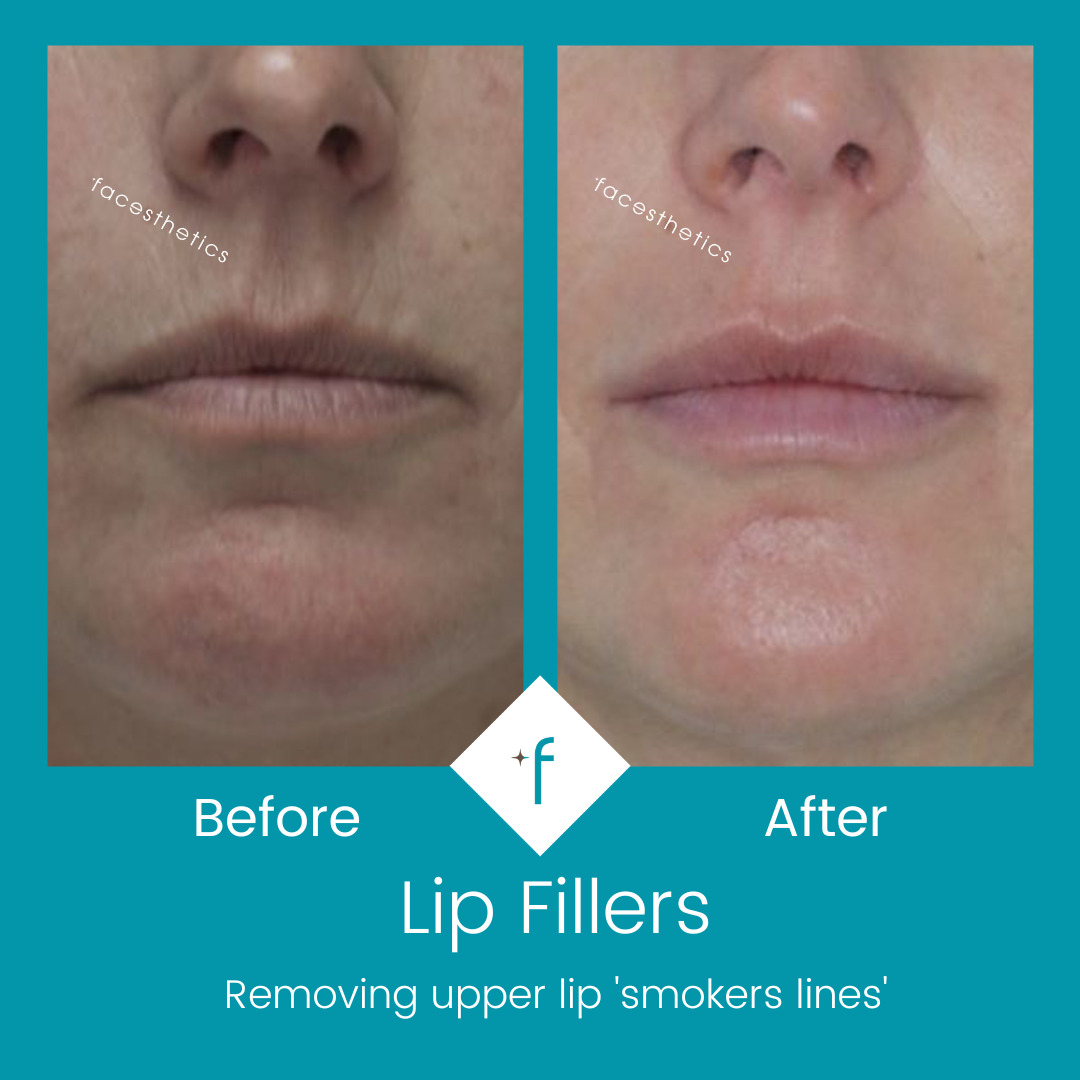 lip-fillers-before-after2