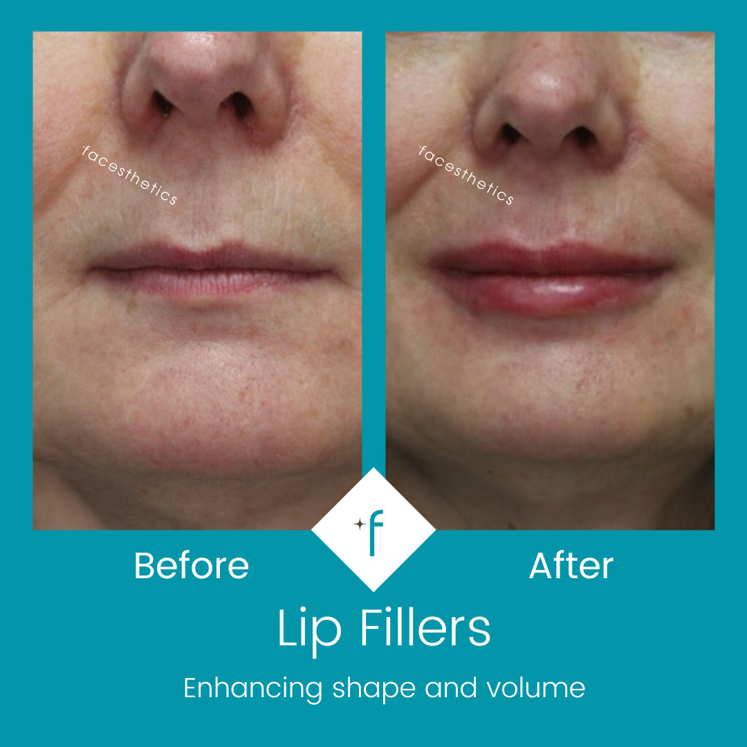 lip-fillers-before-after3