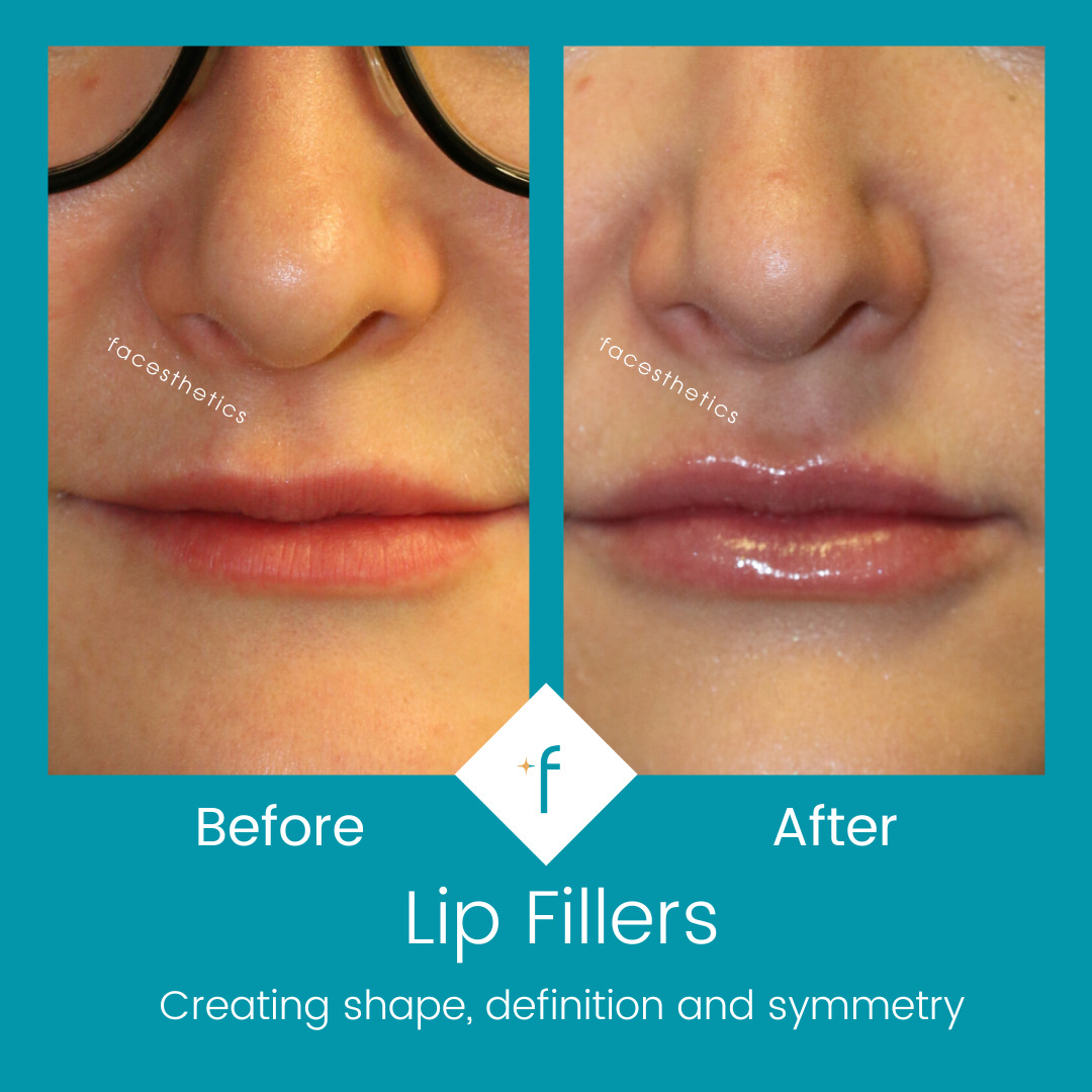 lip-fillers-before-after4