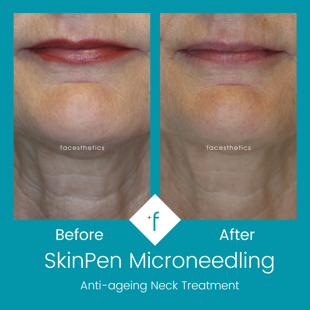 skinpen-microneedling-before-after1