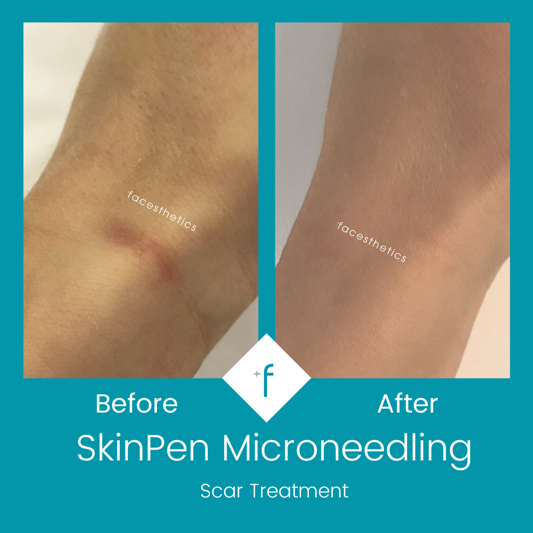 skinpen-microneedling-before-after2