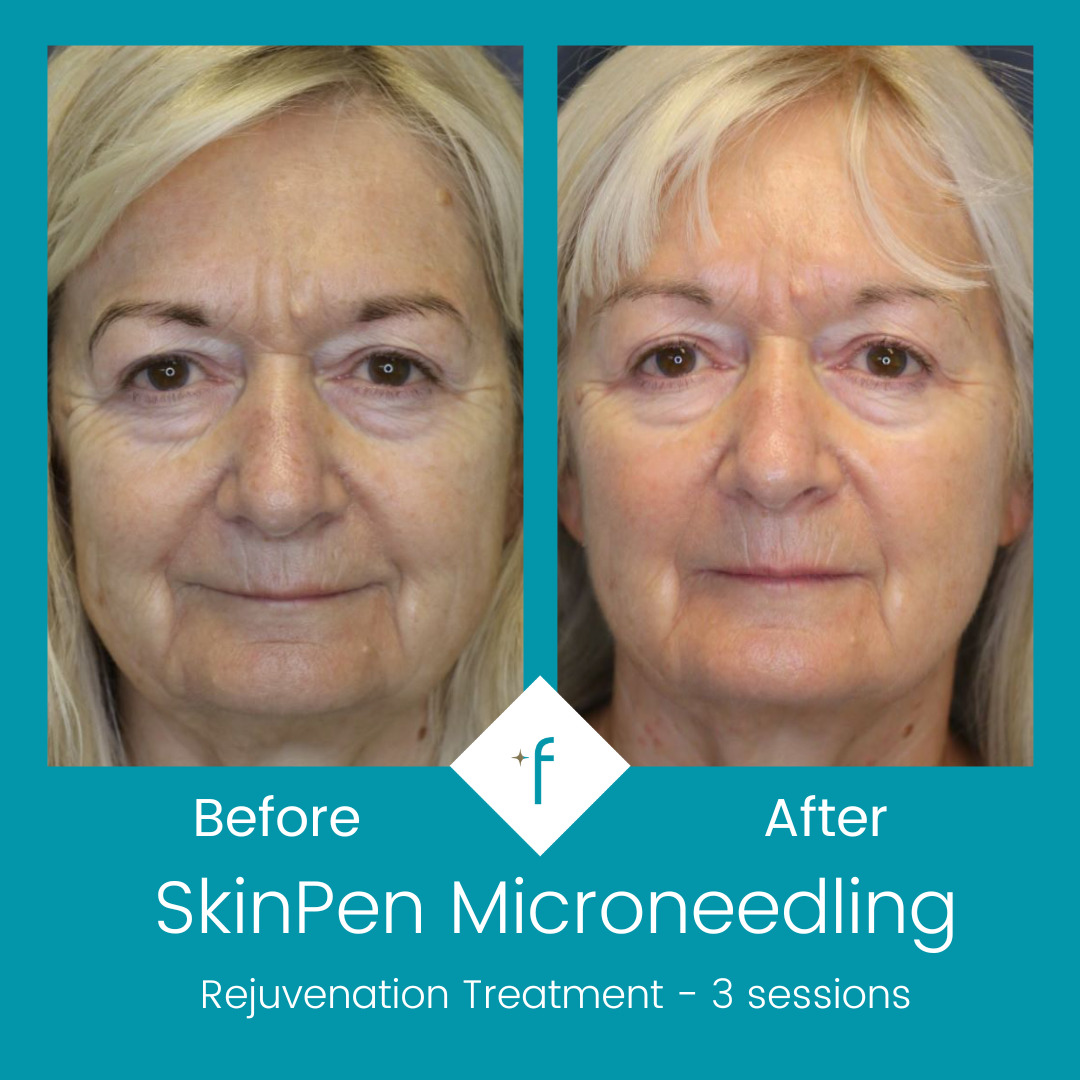 skinpen-microneedling-before-after3