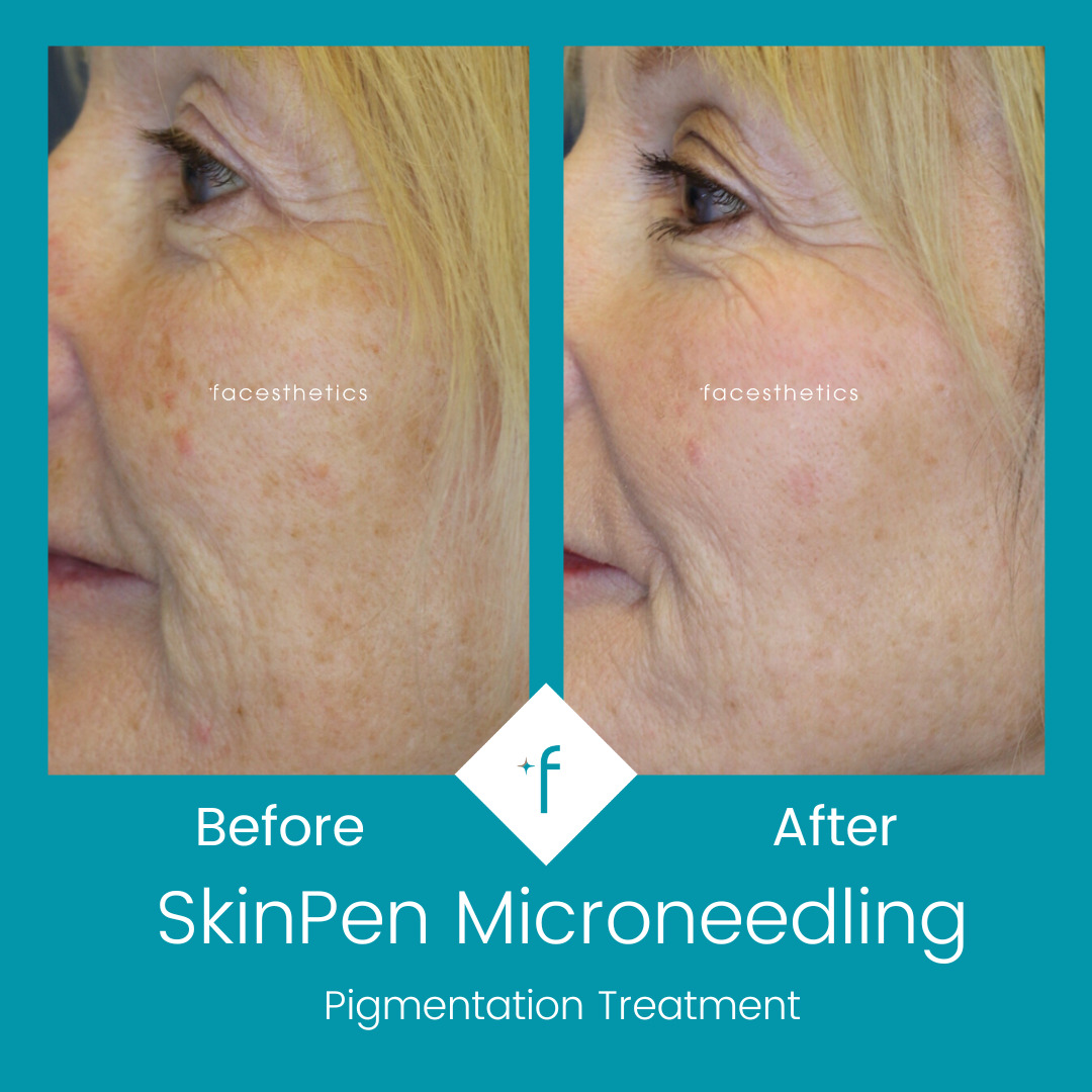 skinpen-microneedling-before-after4