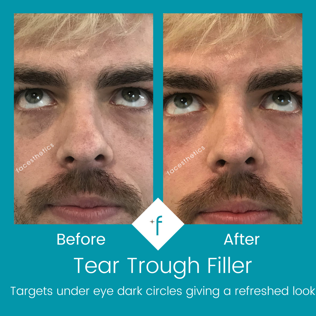 tear-trough-filler-before-after2
