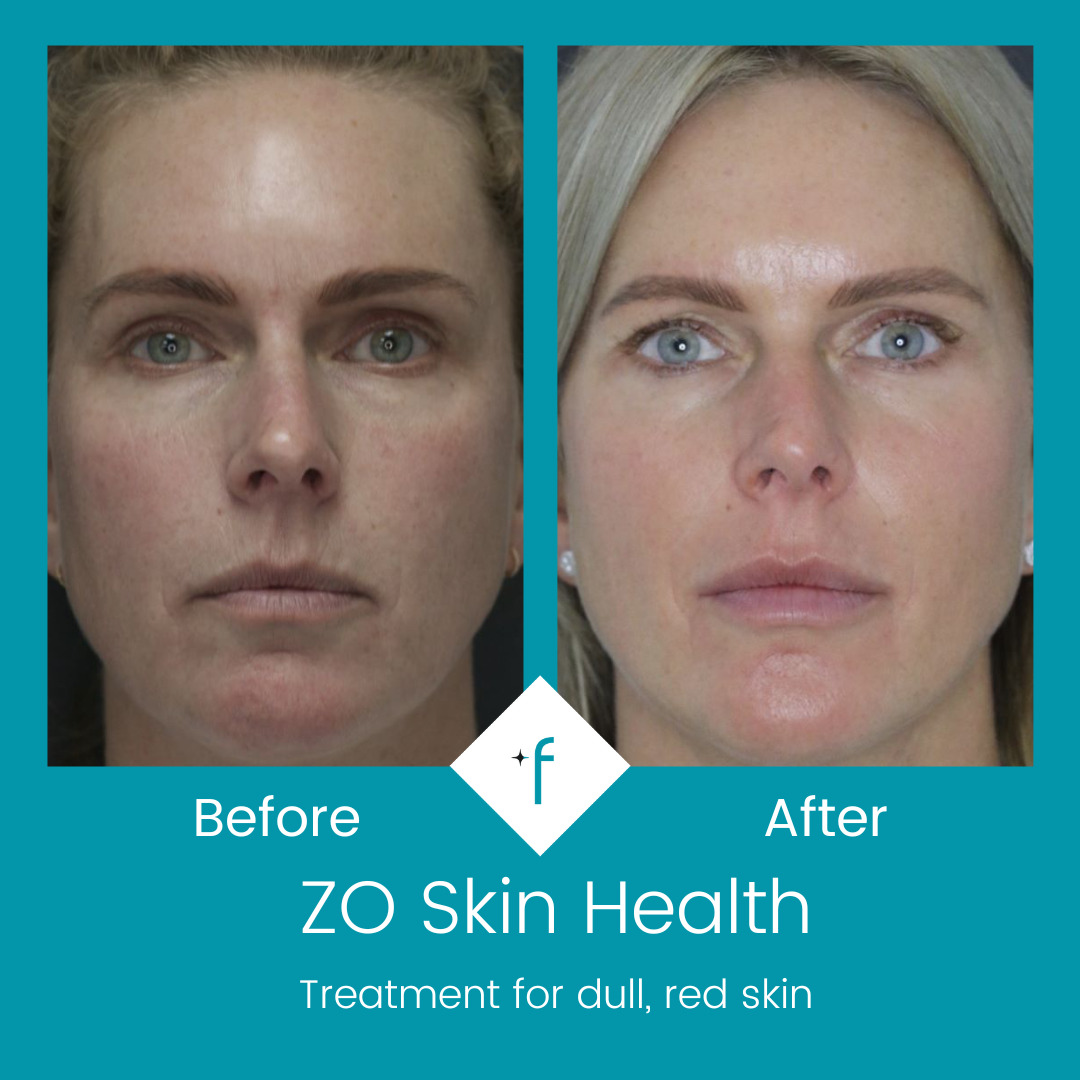 zo-skin-health-before-after1
