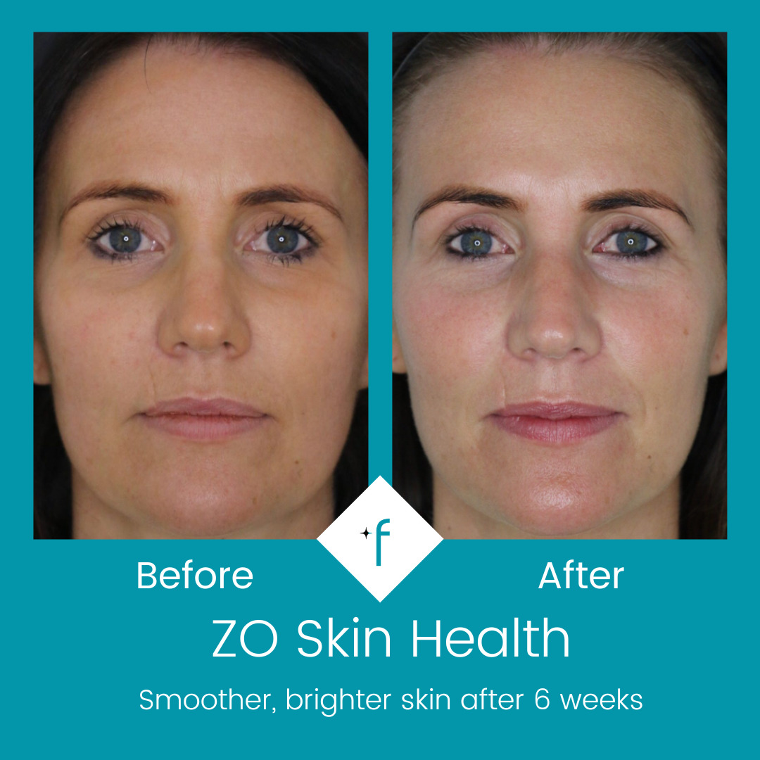zo-skin-health-before-after2