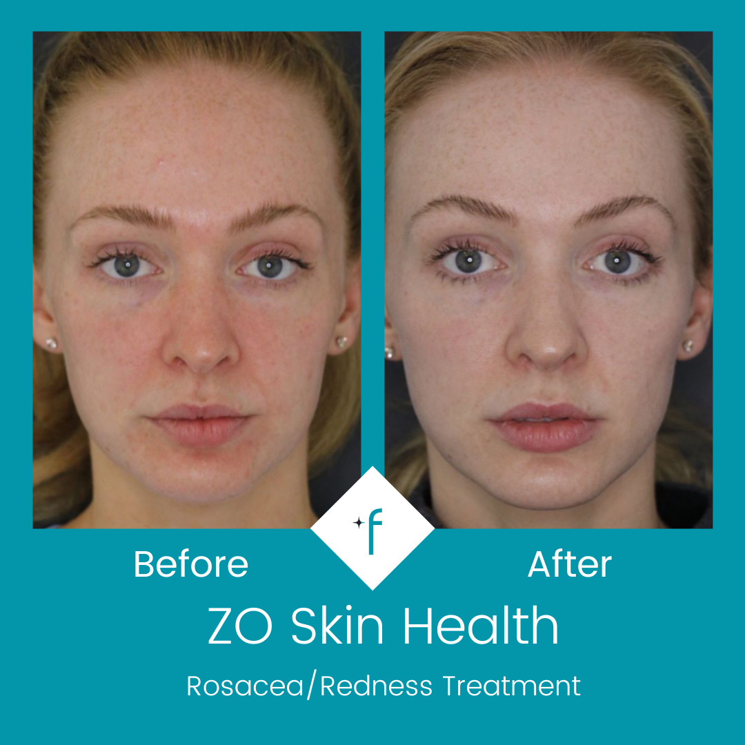 zo-skin-health-before-after3