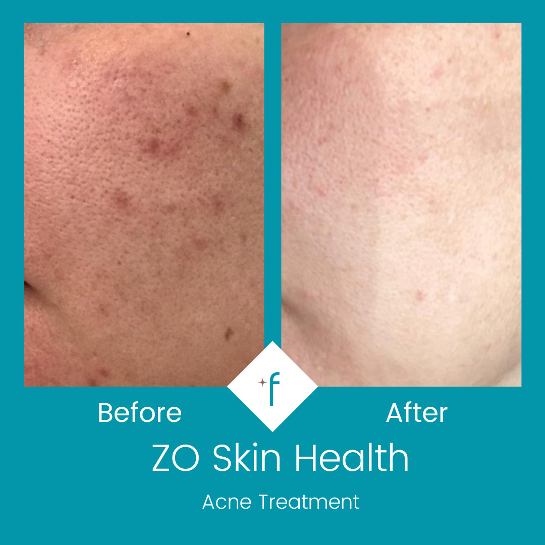 zo-skin-health-before-after4