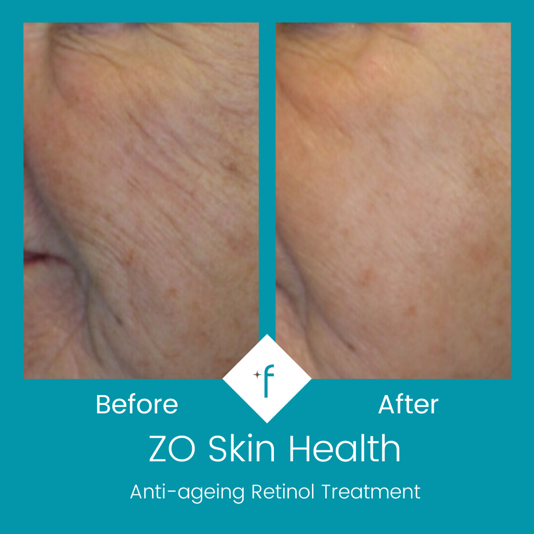 zo-skin-health-before-after5